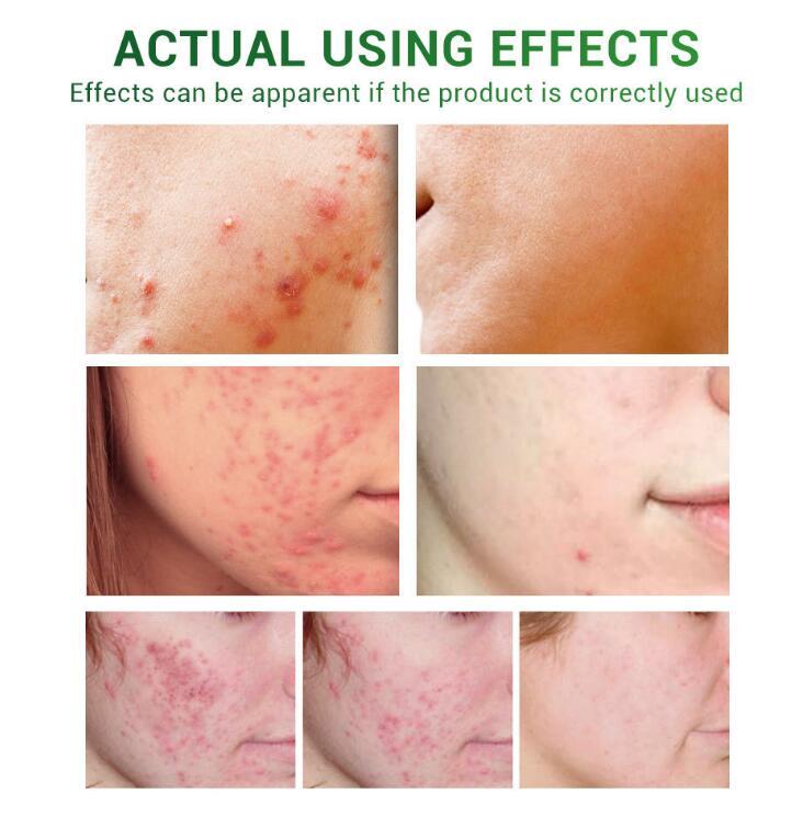 Acne Treatment Serum – Facial Repair Oil for Clear, Healthy Skin