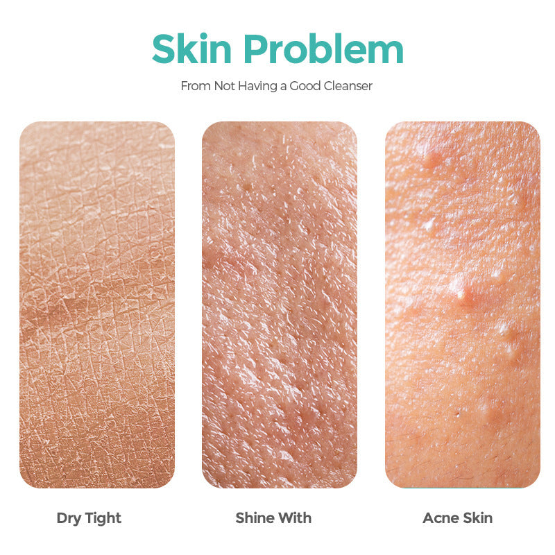 Salicylate Acne Cleanser – 100ml Deep Clean & Hydrating Facial Wash