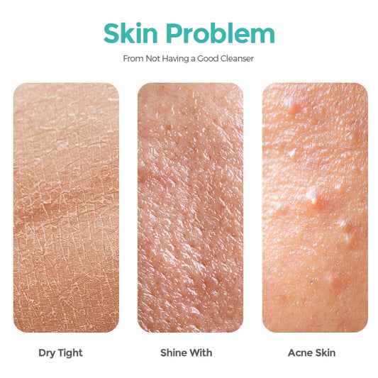 Salicylate Acne Cleanser – 100ml Deep Clean & Hydrating Facial Wash